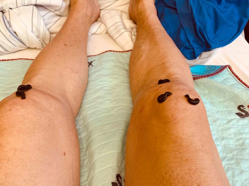hirudothérapie sur les jambes